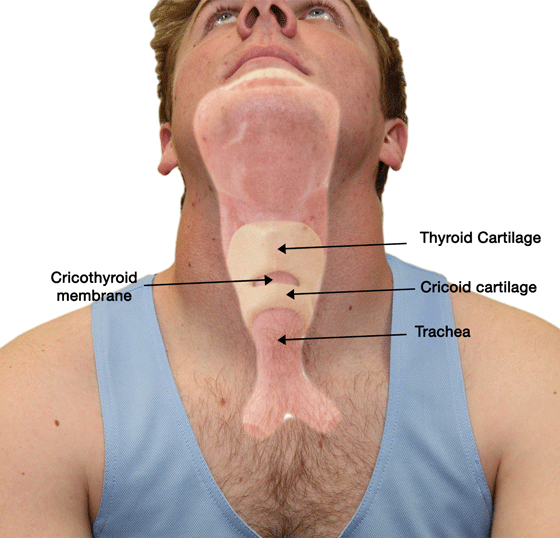 Cricothyrotomy