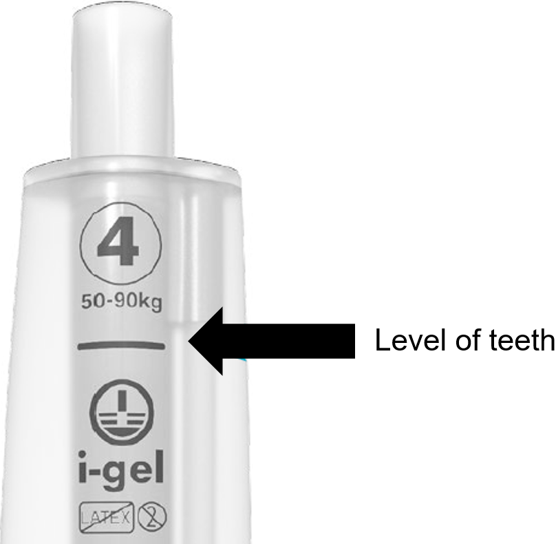 SGA - iGel Teeth