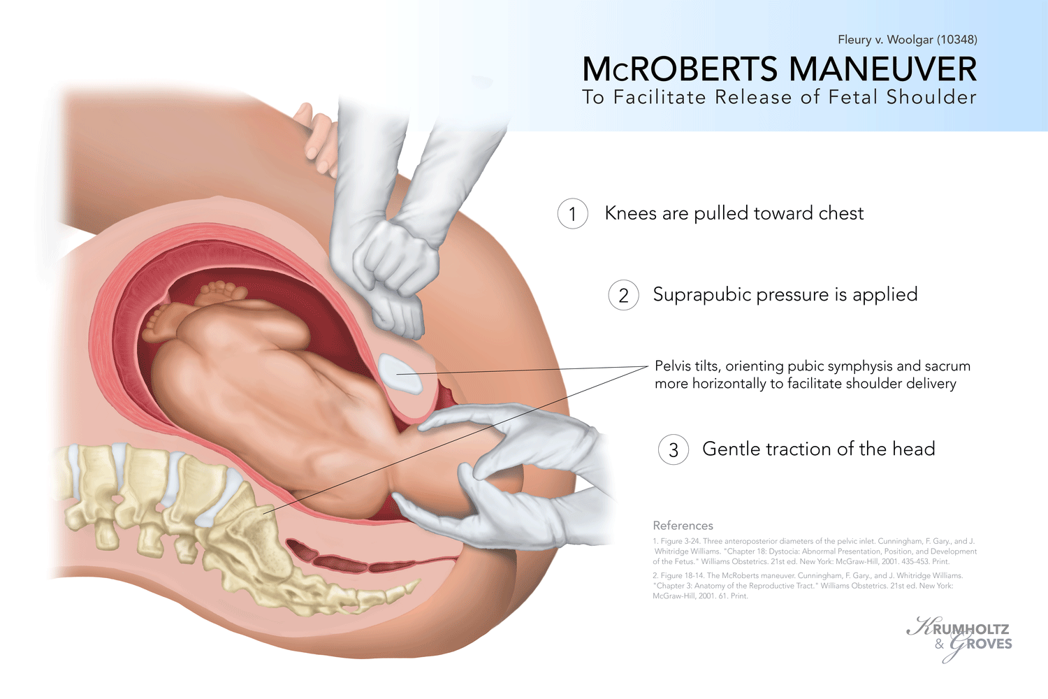 Obstetric - McRoberts