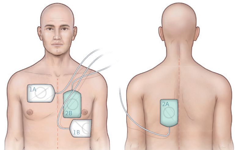 Defib pad placement for vector change and DSED