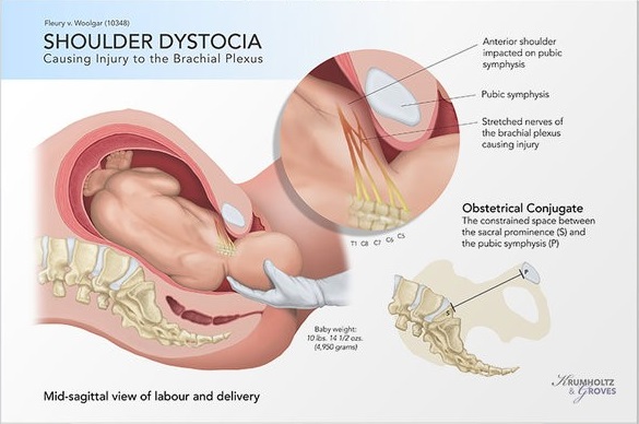 Shoulder-Dystocia